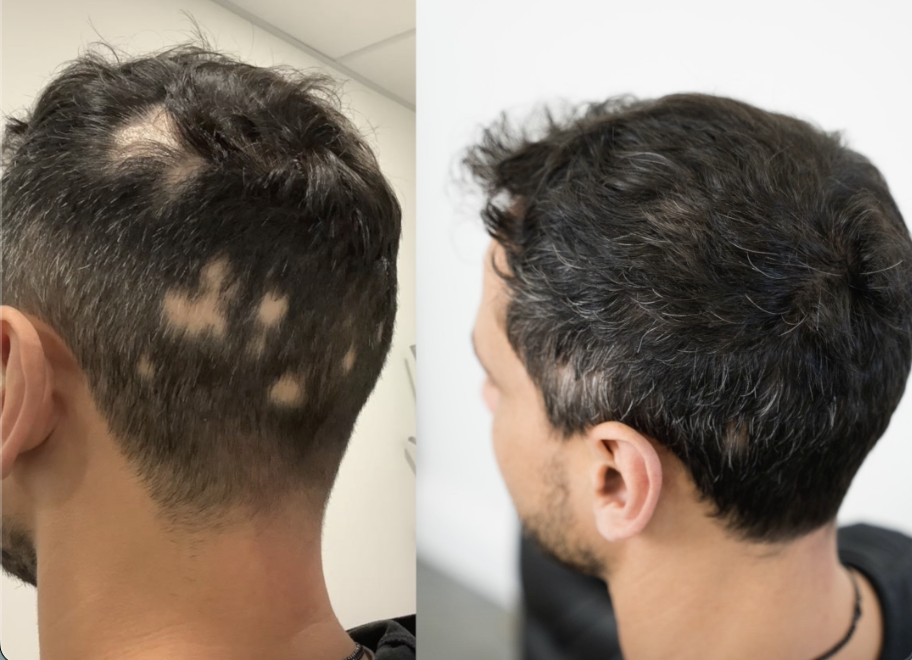 After 20Years Of Alopecia, Man Gets His Hair Back Este